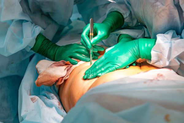 Primo piano dei medici che eseguono un intervento chirurgico sul basso ventre