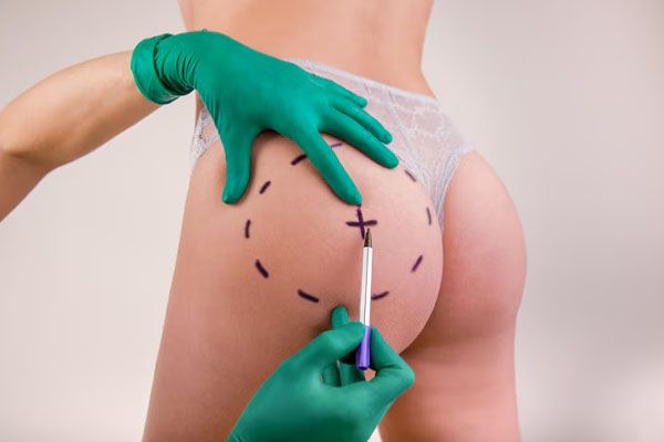 chirurgo che disegna segni sul corpo femminile prima dell'intervento di chirurgia plastica