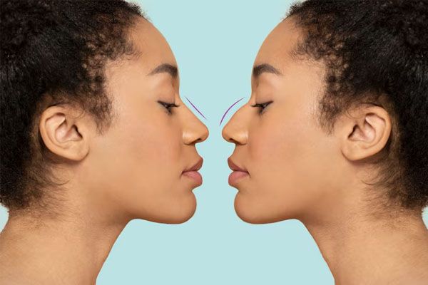 before and after rhinoplasty
