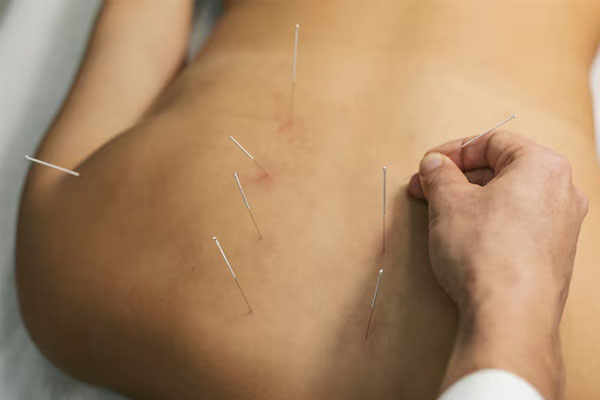 Primo piano di una mano che inserisce gli aghi per agopuntura nella schiena di un paziente